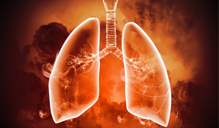 BRONQUIOLITE VIRAL AGUDA